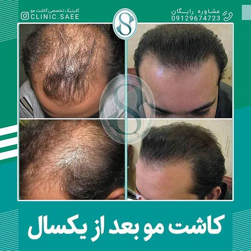 عکس کاشت مو به روش SUT