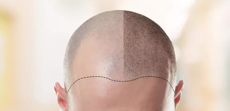 C:\Users\windowa7\Desktop\hair-transplant-02.jpg