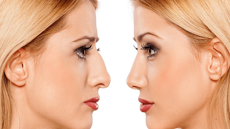 جراحی بینی | دکتر کامبیز ایزدپناه