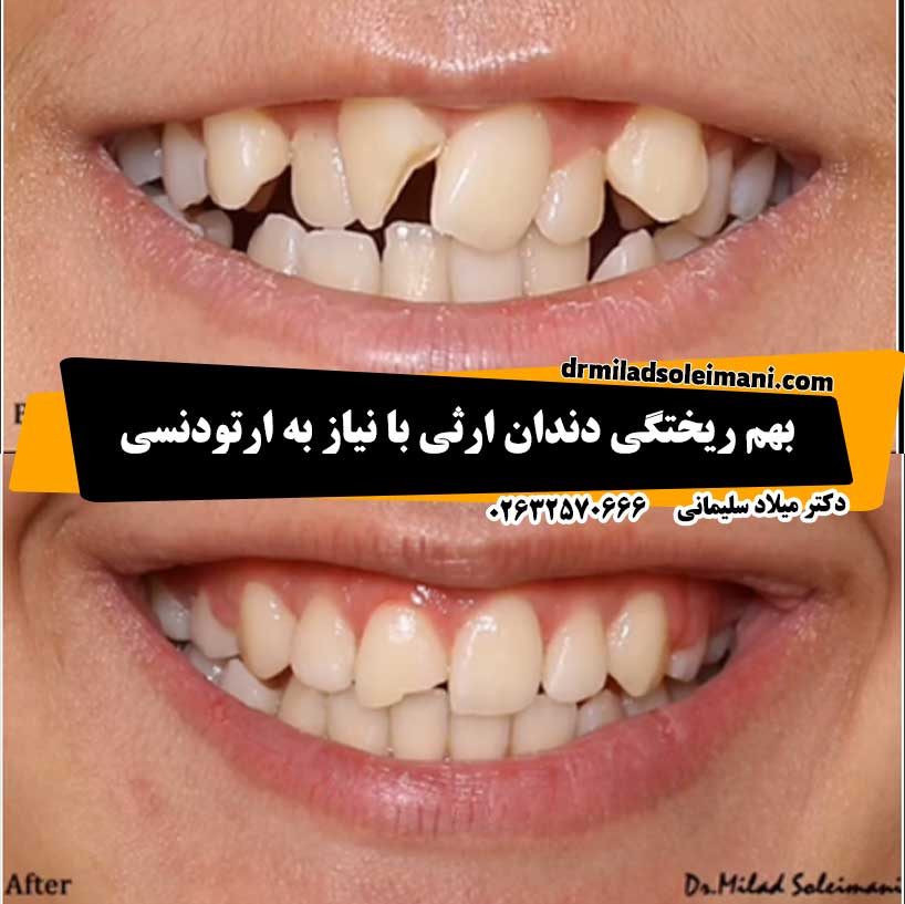 عکس نمونه بهم ریختگی دندان نیاز به ارتودنسی در کرج