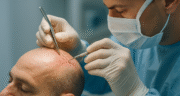 مراحل کاشت مو؛ بررسی کامل روش‌ها، مراحل، مراقبت‌ها، مزایا، هزینه و نتایج