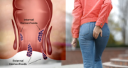 درمان قطعی بواسیر با لیزر؛ پایان دردهای همیشگی در بیماری های نشیمنگاهی