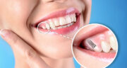 چگونه طول عمر ایمپلنت خود را افزایش دهیم؟