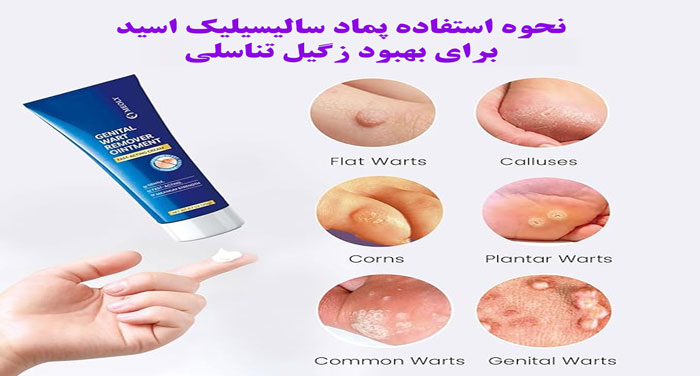 نحوه استفاده پماد سالیسیلیک اسید برای بهبود زگیل تناسلی