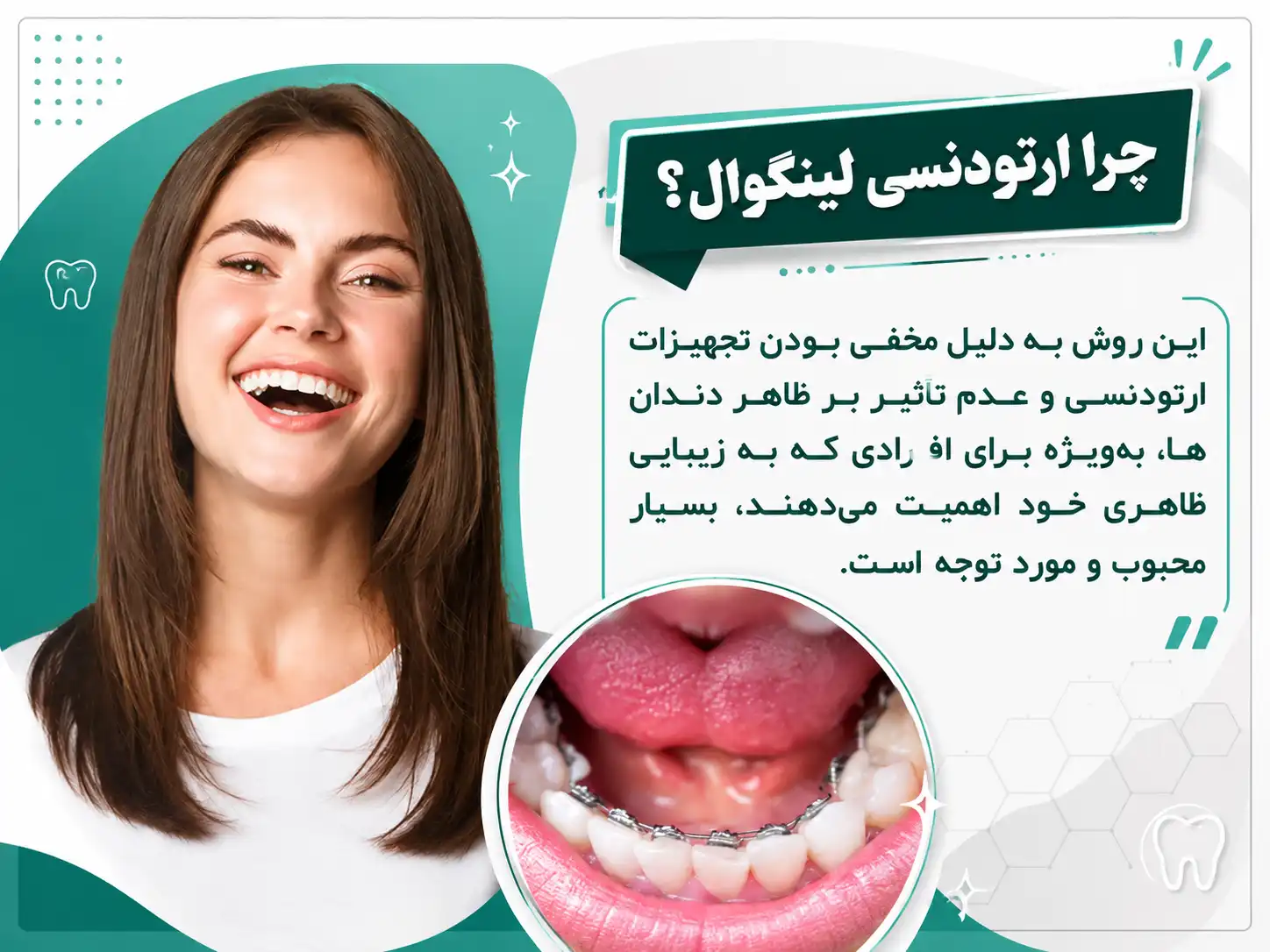 ارتودنسی نامرئی لینگوال در کرج